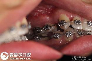 成人蛀牙拔牙全过程视频,揭秘成人拔牙的真实体验