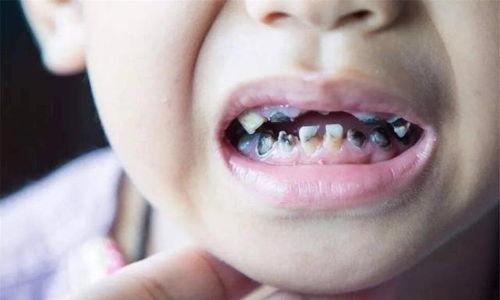 成人吃糖牙齿烂掉的视频