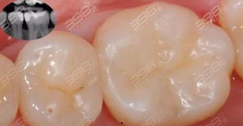 成人补牙事故视频大全集,警惕补牙风险与应对策略